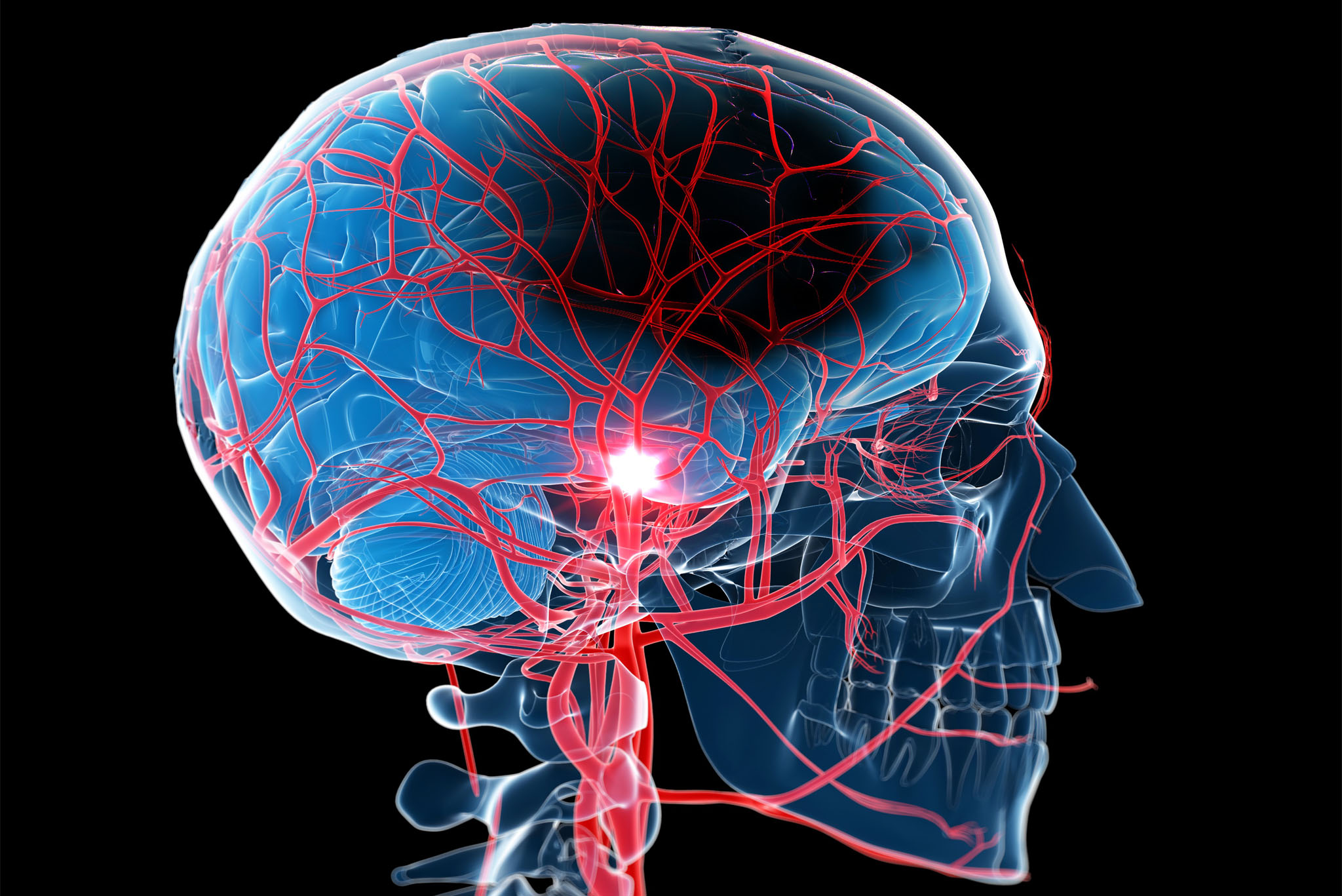 Stroke