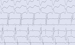 Therapeutic EP Procedures